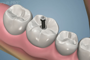 Posterior Single Implant Occlusal Access